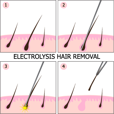 ELECTROLYSIS