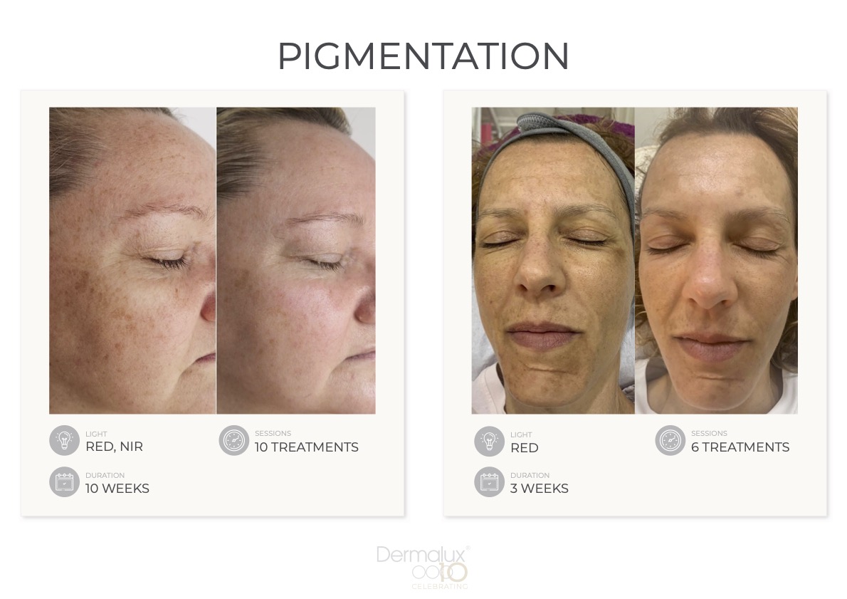 before and after pigmentation treatment