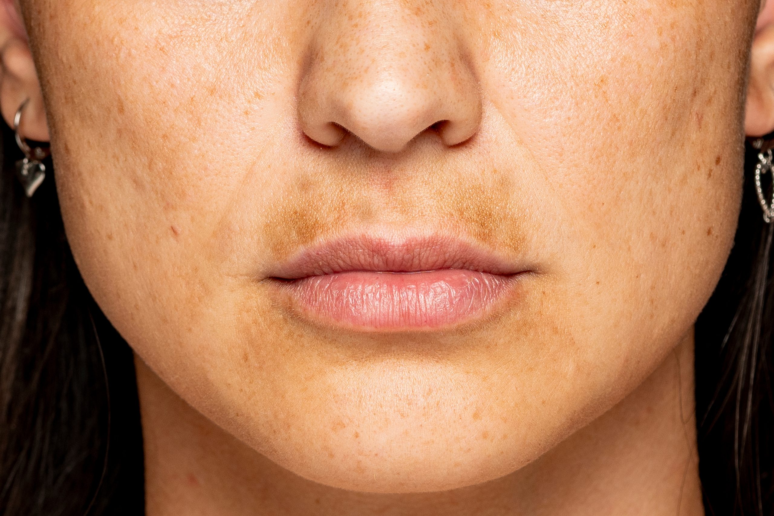 skin pigmentation treatments