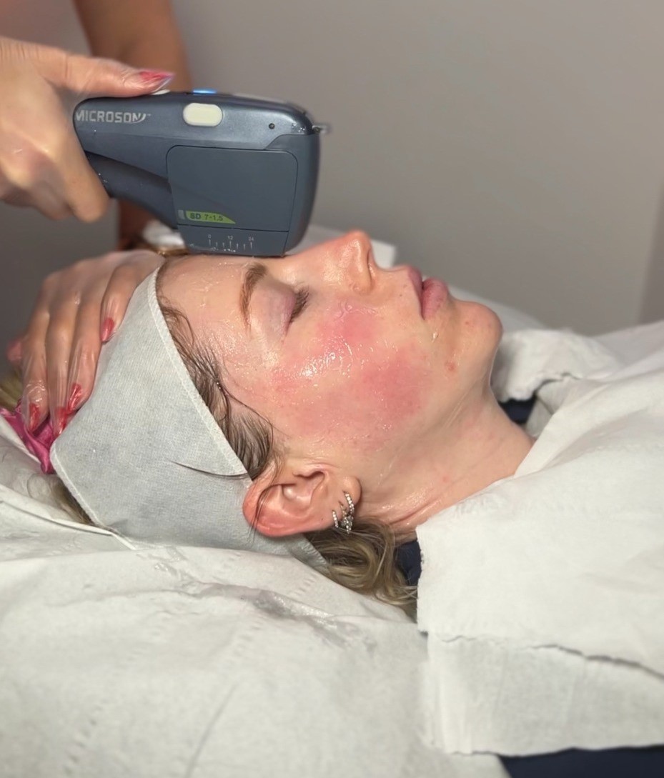 HIFU facial volume loss treatment