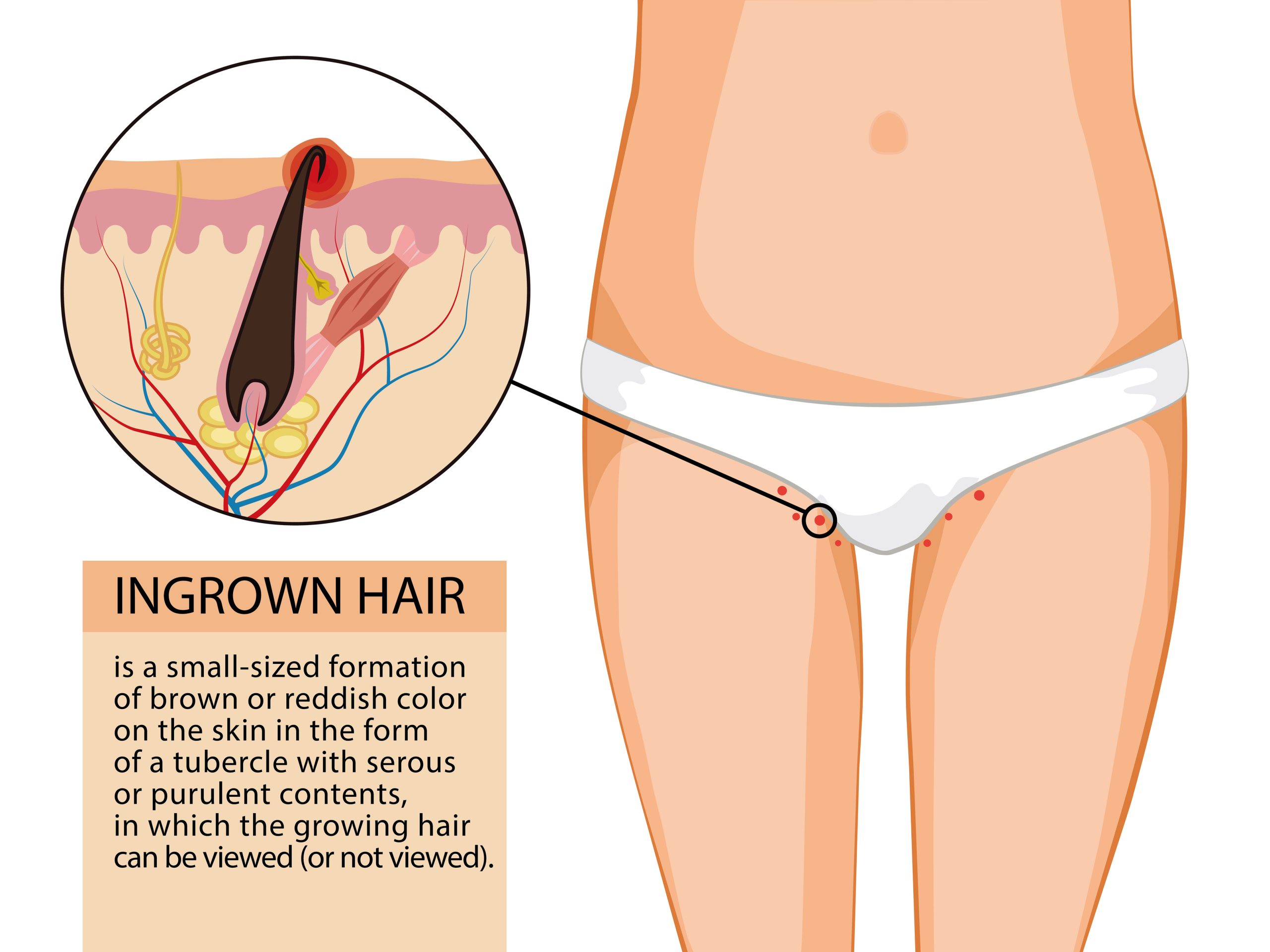 Ingrown hair treatments