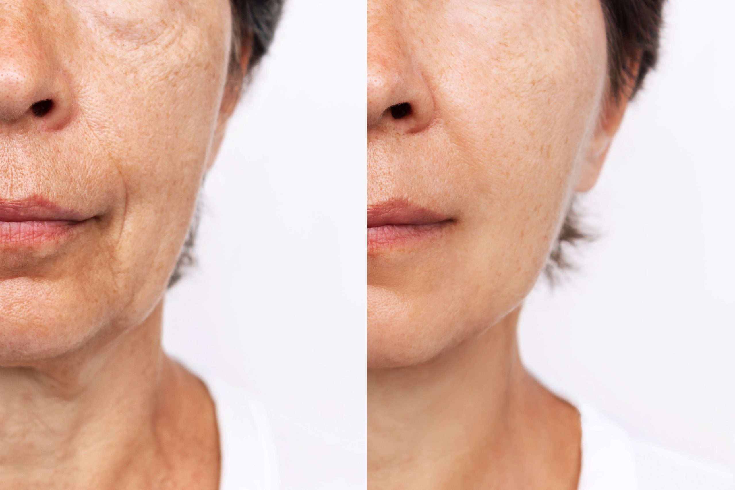 sagging skin treatments