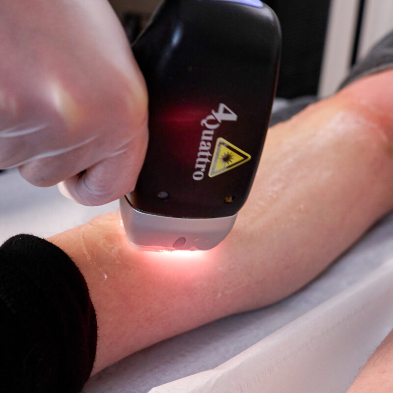laser hair removal at CHEEK